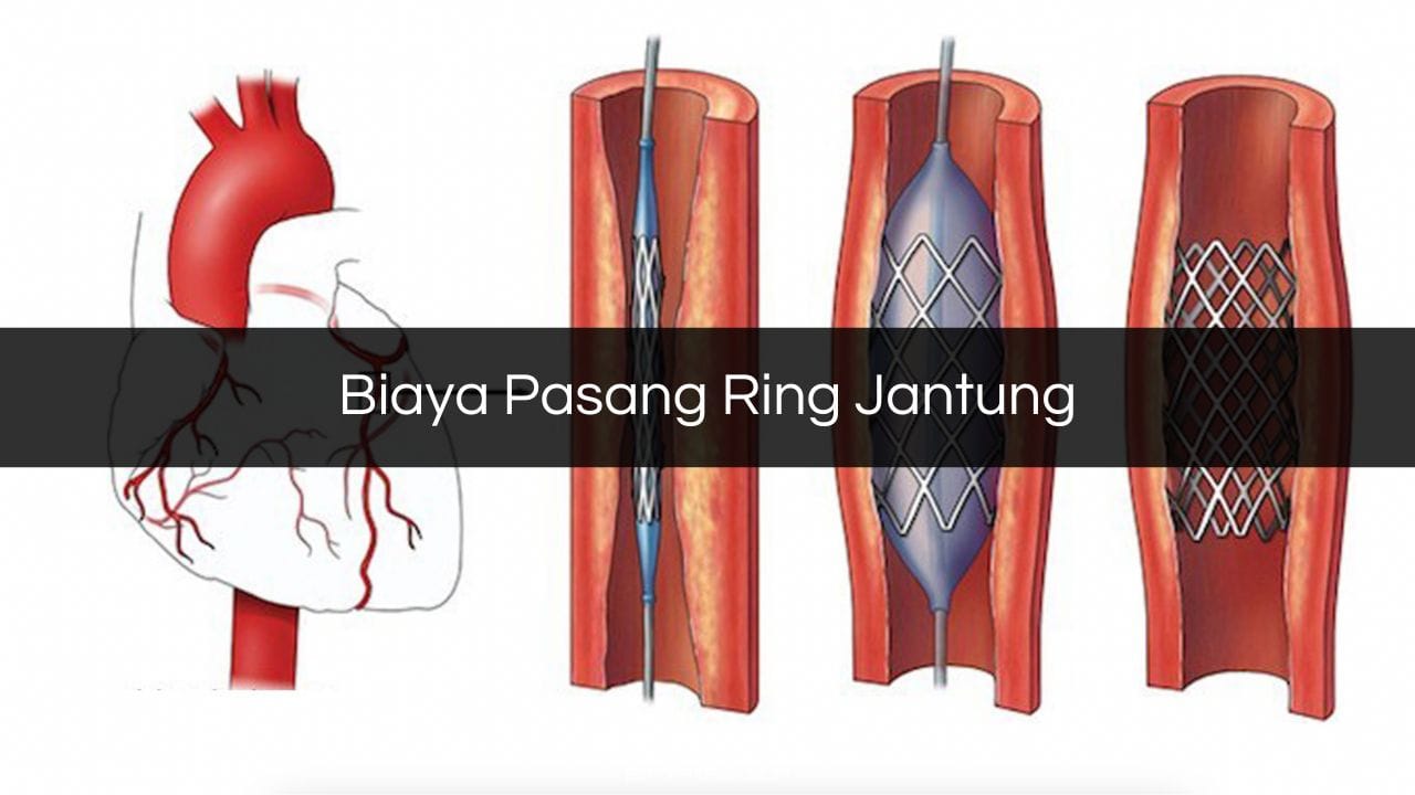 Biaya Pasang Ring Jantung 2023 Pasien Umum BPJS Harga Biaya