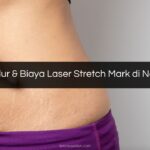 Prosedur & Biaya Laser Stretch Mark di Natasha