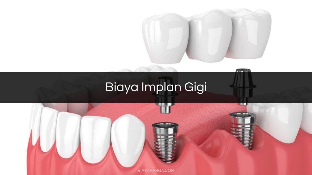 Biaya Implan Gigi