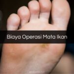 Biaya Operasi Mata Ikan