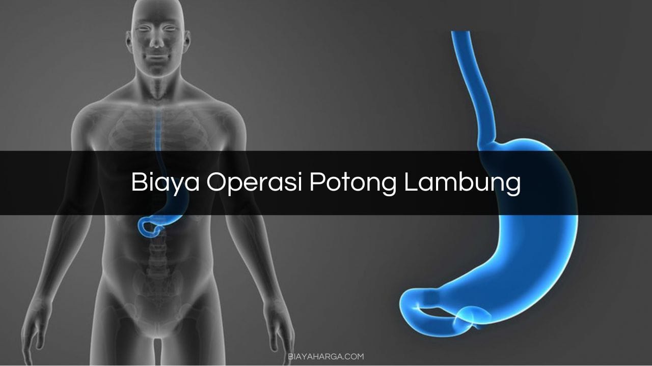 Biaya Operasi Potong Lambung