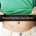 Biaya Operasi Usus Buntu