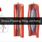 Biaya Pasang Ring Jantung