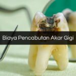 Biaya Pencabutan Akar Gigi