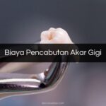 Biaya Pencabutan Akar Gigi