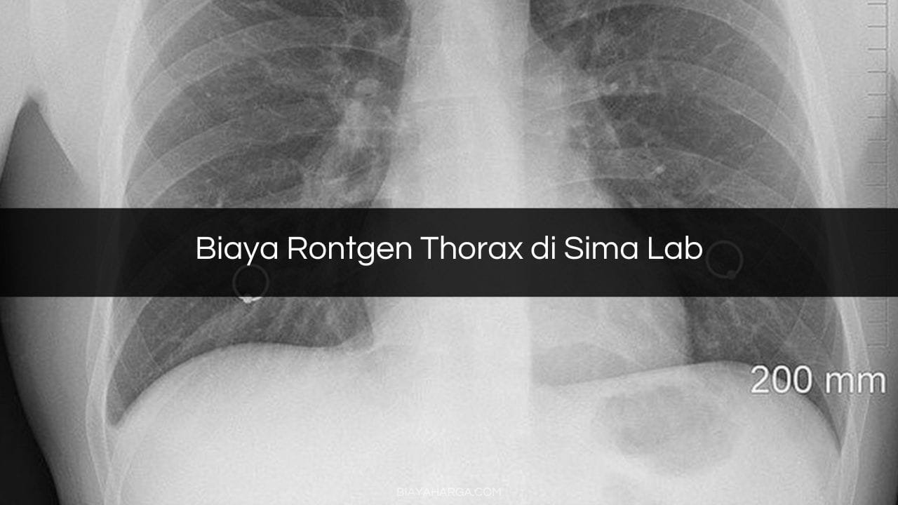 Biaya Rontgen Thorax di Sima Lab