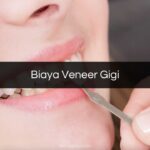 Biaya Veneer Gigi